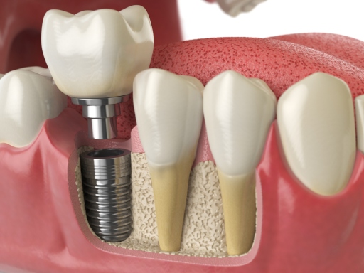 Implant dental by Aberdeen dentist