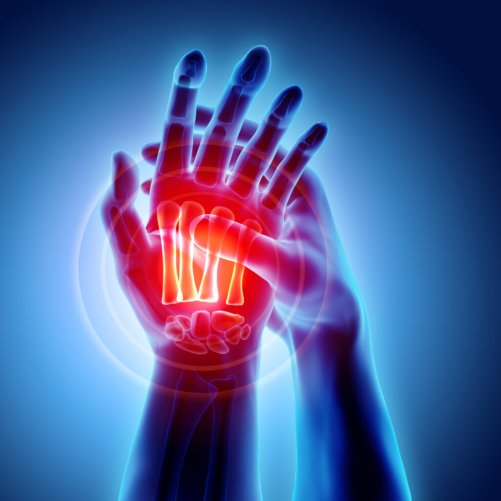 3D illustration of Palm painful - skeleton x-ray, medical concept in Aberdeen