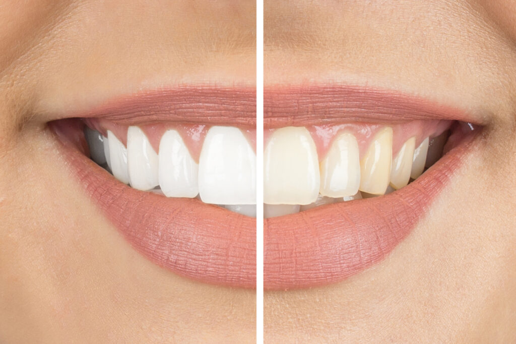 Before and after teeth whitening by Aberdeen Dentist