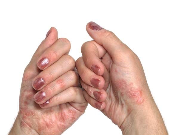 Psoriasis Impact on Oral Health
