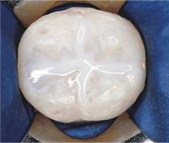 sealant applied by dentist in Olympic Family Dental, Aberdeen, WA