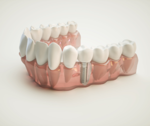 Dental-Implant by dentist in Aberdeen, WA