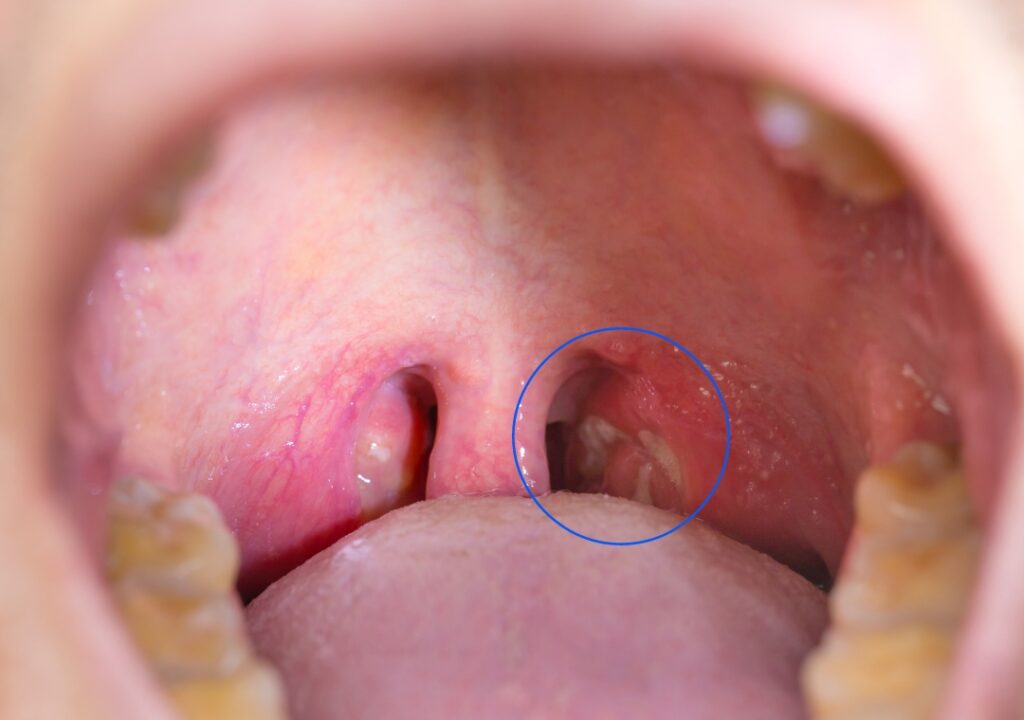 Tonsil-Stone of dental patient in Aberdeen WA