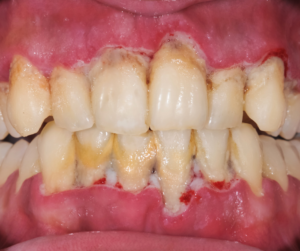 periodontal disease which needs a dentist